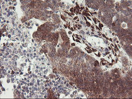 RFXANK Antibody - IHC of paraffin-embedded Adenocarcinoma of Human ovary tissue using anti-RFXANK mouse monoclonal antibody.