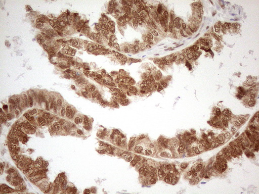 RGL2 Antibody - Immunohistochemical staining of paraffin-embedded Adenocarcinoma of Human ovary tissue using anti-RGL2 mouse monoclonal antibody. (Heat-induced epitope retrieval by 1mM EDTA in 10mM Tris buffer. (pH8.5) at 120°C for 3 min. (1:150)