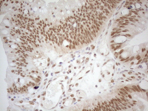 RGL2 Antibody - Immunohistochemical staining of paraffin-embedded Carcinoma of Human pancreas tissue using anti-RGL2 mouse monoclonal antibody. (Heat-induced epitope retrieval by 1mM EDTA in 10mM Tris buffer. (pH8.5) at 120°C for 3 min. (1:150)
