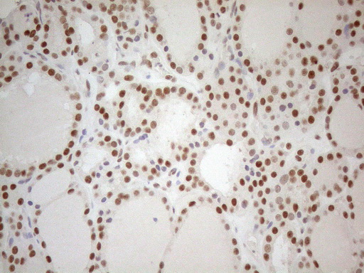 RGL2 Antibody - Immunohistochemical staining of paraffin-embedded Human thyroid tissue using anti-RGL2 mouse monoclonal antibody. (Heat-induced epitope retrieval by 1mM EDTA in 10mM Tris buffer. (pH8.5) at 120°C for 3 min. (1:150)