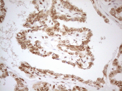 RGL2 Antibody - Immunohistochemical staining of paraffin-embedded Carcinoma of Human thyroid tissue using anti-RGL2 mouse monoclonal antibody. (Heat-induced epitope retrieval by 1mM EDTA in 10mM Tris buffer. (pH8.5) at 120°C for 3 min. (1:150)