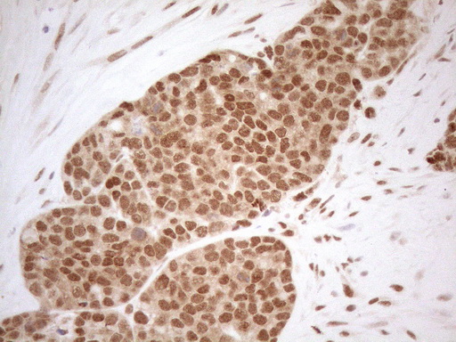 RGL2 Antibody - Immunohistochemical staining of paraffin-embedded Adenocarcinoma of Human endometrium tissue using anti-RGL2 mouse monoclonal antibody. (Heat-induced epitope retrieval by 1mM EDTA in 10mM Tris buffer. (pH8.5) at 120°C for 3 min. (1:150)