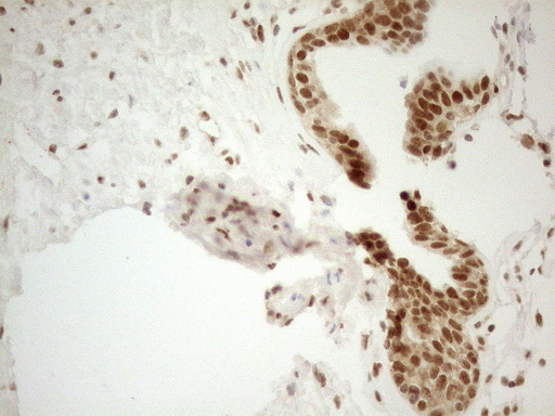 RGL2 Antibody - Immunohistochemical staining of paraffin-embedded Carcinoma of Human prostate tissue using anti-RGL2 mouse monoclonal antibody. (Heat-induced epitope retrieval by 1mM EDTA in 10mM Tris buffer. (pH8.5) at 120°C for 3 min. (1:150)