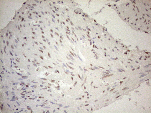 RGL2 Antibody - Immunohistochemical staining of paraffin-embedded Carcinoma of Human bladder tissue using anti-RGL2 mouse monoclonal antibody. (Heat-induced epitope retrieval by 1mM EDTA in 10mM Tris buffer. (pH8.5) at 120°C for 3 min. (1:150)