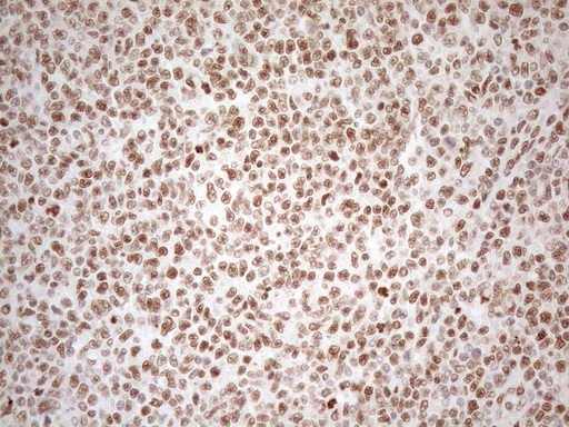 RGL2 Antibody - Immunohistochemical staining of paraffin-embedded Human lymphoma tissue using anti-RGL2 mouse monoclonal antibody. (Heat-induced epitope retrieval by 1mM EDTA in 10mM Tris buffer. (pH8.5) at 120°C for 3 min. (1:150)