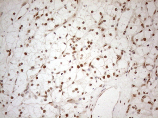 RGL2 Antibody - Immunohistochemical staining of paraffin-embedded Carcinoma of Human kidney tissue using anti-RGL2 mouse monoclonal antibody. (Heat-induced epitope retrieval by 1mM EDTA in 10mM Tris buffer. (pH8.5) at 120°C for 3 min. (1:150)