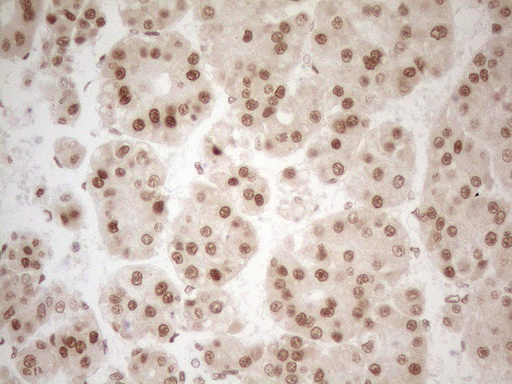 RGL2 Antibody - Immunohistochemical staining of paraffin-embedded Carcinoma of Human liver tissue using anti-RGL2 mouse monoclonal antibody. (Heat-induced epitope retrieval by 1mM EDTA in 10mM Tris buffer. (pH8.5) at 120°C for 3 min. (1:150)