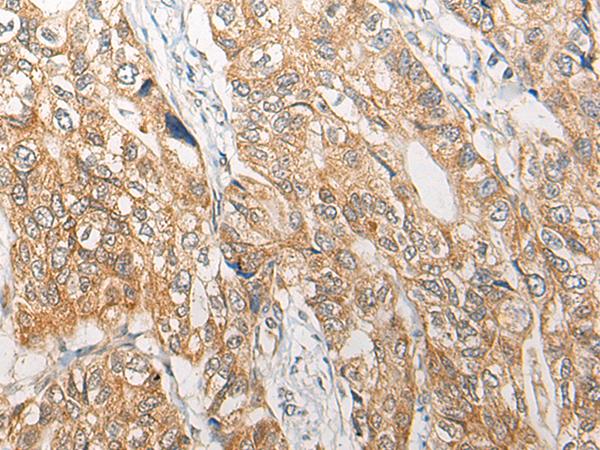 RGN / Regucalcin Antibody - Immunohistochemistry of paraffin-embedded Human gastric cancer tissue  using RGN Polyclonal Antibody at dilution of 1:25(×200)
