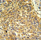 RGP1 Antibody - Formalin-fixed and paraffin-embedded human lung carcinoma reacted with RGP1 Antibody , which was peroxidase-conjugated to the secondary antibody, followed by DAB staining. This data demonstrates the use of this antibody for immunohistochemistry; clinical relevance has not been evaluated.