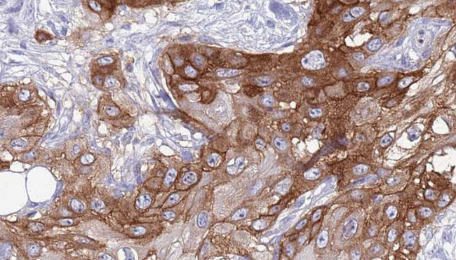 RGR Antibody - 1:100 staining human Head and neck carcinoma tissue by IHC-P. The sample was formaldehyde fixed and a heat mediated antigen retrieval step in citrate buffer was performed. The sample was then blocked and incubated with the antibody for 1.5 hours at 22°C. An HRP conjugated goat anti-rabbit antibody was used as the secondary.