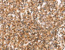 RGS1 Antibody - Immunohistochemistry of paraffin-embedded Human prostate cancer using RGS1 Polyclonal Antibody at dilution of 1:20.