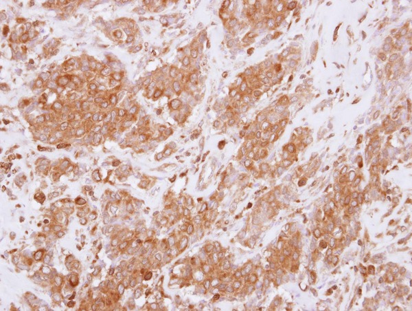 RGS10 Antibody - IHC of paraffin-embedded Breast ca using RGS10 antibody at 1:250 dilution.