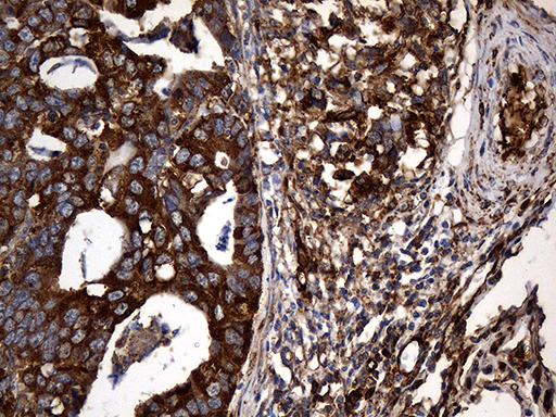 RGS10 Antibody - Immunohistochemical staining of paraffin-embedded Human Gastric Carcinoma using anti-RGS10 mouse monoclonal antibody. (Heat-induced epitope retrieval by 1mM EDTA in 10mM Tris buffer. (pH8.5) at 120°C for 3 min. (1:2000)