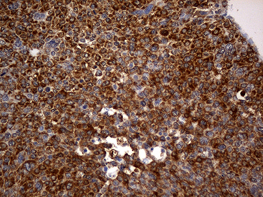RGS10 Antibody - Immunohistochemical staining of paraffin-embedded Carcinoma of Human liver tissue using anti-RGS10 mouse monoclonal antibody. (Heat-induced epitope retrieval by 1mM EDTA in 10mM Tris buffer. (pH8.5) at 120°C for 3 min. (1:2000)