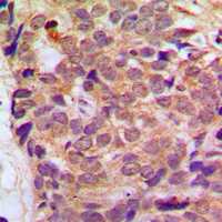 RGS10 Antibody - Immunohistochemical analysis of RGS10 staining in human breast cancer formalin fixed paraffin embedded tissue section. The section was pre-treated using heat mediated antigen retrieval with sodium citrate buffer (pH 6.0). The section was then incubated with the antibody at room temperature and detected using an HRP conjugated compact polymer system. DAB was used as the chromogen. The section was then counterstained with hematoxylin and mounted with DPX.