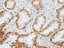 RGS14 Antibody - IHC of paraffin-embedded GASTRIC CA using RGS14 antibody at 1:100 dilution.
