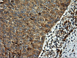 RGS16 Antibody - IHC of paraffin-embedded Carcinoma of Human bladder tissue using anti-RGS16 mouse monoclonal antibody. (Heat-induced epitope retrieval by 10mM citric buffer, pH6.0, 100C for 10min).