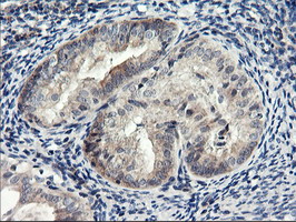 RGS16 Antibody - IHC of paraffin-embedded Adenocarcinoma of Human endometrium tissue using anti-RGS16 mouse monoclonal antibody.