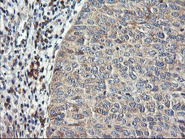 RGS16 Antibody - IHC of paraffin-embedded Carcinoma of Human bladder tissue using anti-RGS16 mouse monoclonal antibody.