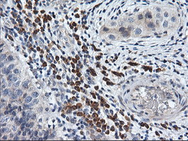 RGS16 Antibody - IHC of paraffin-embedded Carcinoma of Human bladder tissue using anti-RGS16 mouse monoclonal antibody.