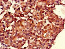 RGS19 Antibody - Immunohistochemistry of paraffin-embedded human breast cancer using RGS19 Antibody at dilution of 1:100