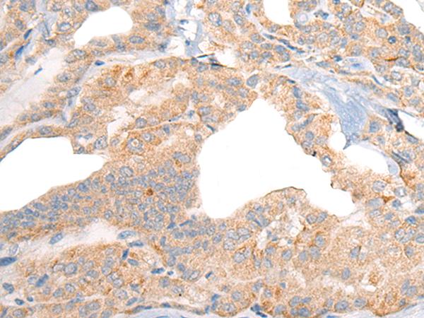 RGS19 Antibody - Immunohistochemistry of paraffin-embedded Human thyroid cancer tissue  using RGS19 Polyclonal Antibody at dilution of 1:40(×200)