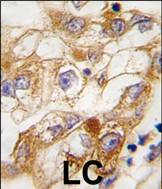 RGS19 Antibody - Formalin-fixed and paraffin-embedded human lung carcinoma tissue reacted with RGS19 Antibody (S24) , which was peroxidase-conjugated to the secondary antibody, followed by DAB staining. This data demonstrates the use of this antibody for immunohistochemistry; clinical relevance has not been evaluated.