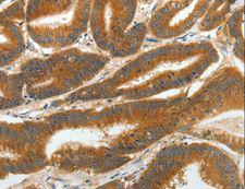 RGS2 Antibody - Immunohistochemistry of paraffin-embedded Human ovarian cancer using RGS2 Polyclonal Antibody at dilution of 1:40.