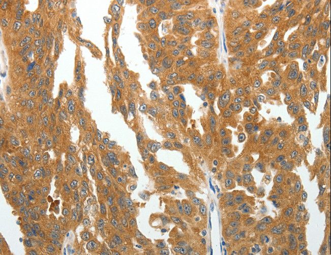 RGS2 Antibody - Immunohistochemistry of paraffin-embedded Human ovarian cancer using RGS2 Polyclonal Antibody at dilution of 1:40.