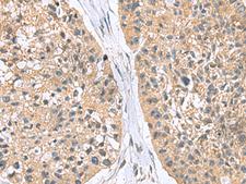 RGS2 Antibody - Immunohistochemistry of paraffin-embedded Human esophagus cancer tissue  using RGS2 Polyclonal Antibody at dilution of 1:95(×200)