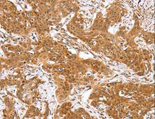 RGS22 Antibody - Immunohistochemistry of paraffin-embedded Human cervical cancer using RGS22 Polyclonal Antibody at dilution of 1:40.