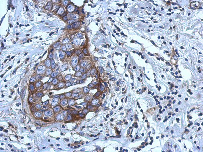 RGS4 Antibody - IHC of paraffin-embedded Breast ca using RGS4 antibody at 1:500 dilution.