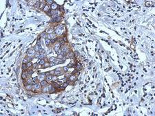 RGS4 Antibody - IHC of paraffin-embedded Breast ca using RGS4 antibody at 1:500 dilution.
