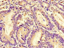 RGS4 Antibody - Immunohistochemistry of paraffin-embedded human colon cancer using RGS4 Antibody at dilution of 1:100