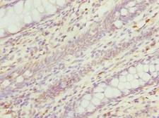 RGS5 Antibody - Immunohistochemistry of paraffin-embedded human colon cancer tissue at dilution 1:100