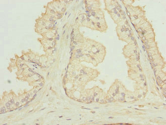 RGS5 Antibody - Immunohistochemistry of paraffin-embedded human prostata cancer at dilution 1:100
