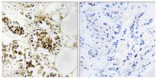 RGS5 Antibody - Peptide - + Immunohistochemistry analysis of paraffin-embedded human breast carcinoma tissue, using RGS5 antibody.