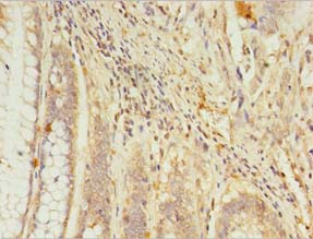 RGS7 Antibody - Immunohistochemistry of paraffin-embedded human colon cancer using antibody at 1:100 dilution.