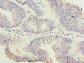 RGS7 Antibody - Immunohistochemistry of paraffin-embedded human endometrial cancer at dilution 1:100