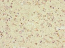 RGS9 Antibody - Immunohistochemistry of paraffin-embedded human glioma at dilution 1:100