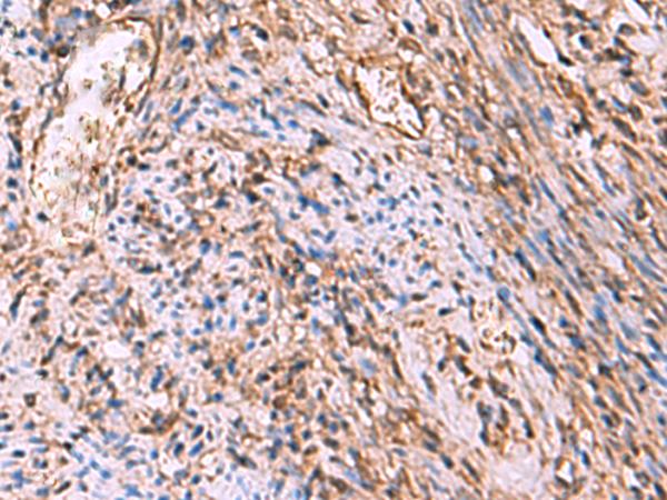 RHAG Antibody - Immunohistochemistry of paraffin-embedded Human cervical cancer tissue  using RHAG Polyclonal Antibody at dilution of 1:130(×200)