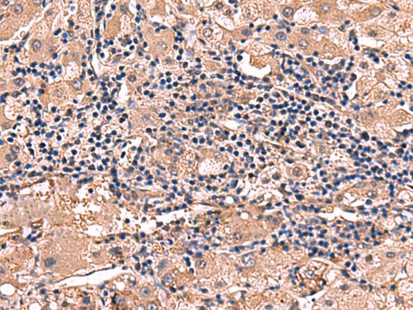 RHAG Antibody - Immunohistochemistry of paraffin-embedded Human liver cancer tissue  using RHAG Polyclonal Antibody at dilution of 1:110(×200)