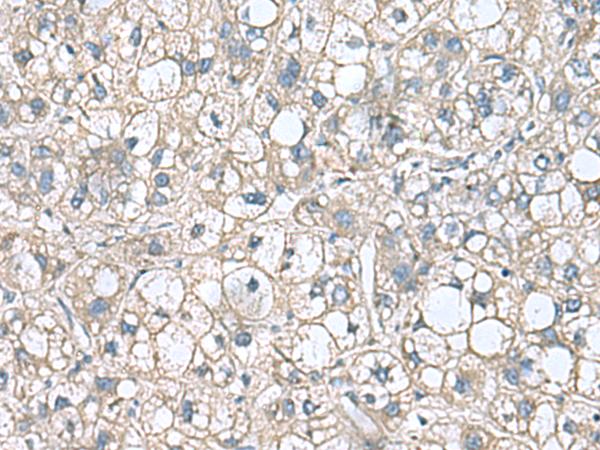 RHBDL2 / RRP2 Antibody - Immunohistochemistry of paraffin-embedded Human liver cancer tissue  using RHBDL2 Polyclonal Antibody at dilution of 1:110(×200)