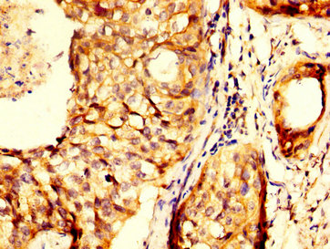 RHCG Antibody - Immunohistochemistry image at a dilution of 1:300 and staining in paraffin-embedded human cervical cancer performed on a Leica BondTM system. After dewaxing and hydration, antigen retrieval was mediated by high pressure in a citrate buffer (pH 6.0) . Section was blocked with 10% normal goat serum 30min at RT. Then primary antibody (1% BSA) was incubated at 4 °C overnight. The primary is detected by a biotinylated secondary antibody and visualized using an HRP conjugated SP system.
