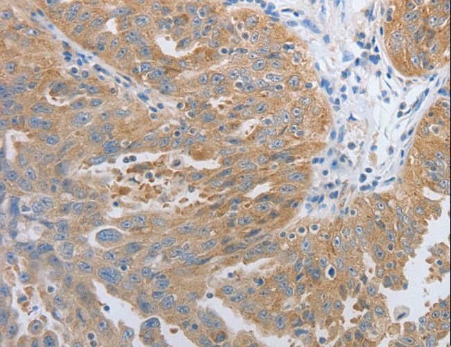 RHEB Antibody - Immunohistochemistry of paraffin-embedded Human ovarian cancer using RHEB Polyclonal Antibody at dilution of 1:30.
