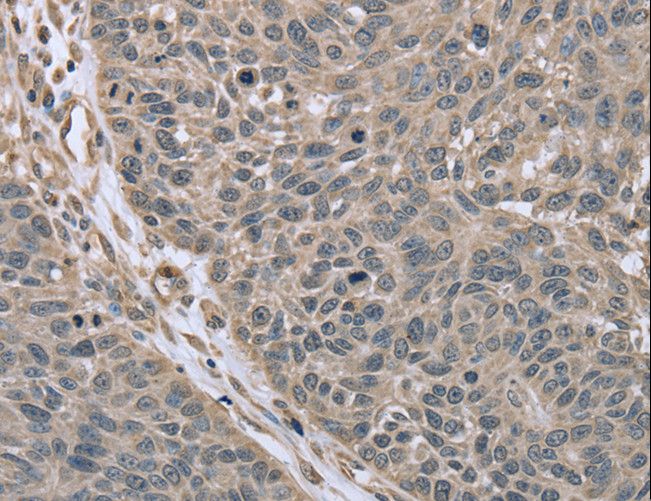 RHEB Antibody - Immunohistochemistry of paraffin-embedded Human lung cancer using RHEB Polyclonal Antibody at dilution of 1:40.