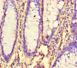 RHEB Antibody - Immunohistochemistry of paraffin-embedded human colon cancer at dilution of 1:100