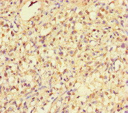 RHEB Antibody - Immunohistochemistry of paraffin-embedded human gastric cancer at dilution of 1:100