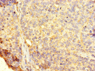 RHEBL1 Antibody - Immunohistochemistry of paraffin-embedded human ovarian cancer using RHEBL1 Antibody at dilution of 1:100