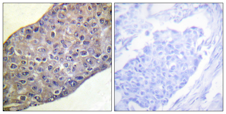RHOA Antibody - Immunohistochemistry analysis of paraffin-embedded human breast carcinoma tissue, using RhoA Antibody. The picture on the right is blocked with the synthesized peptide.